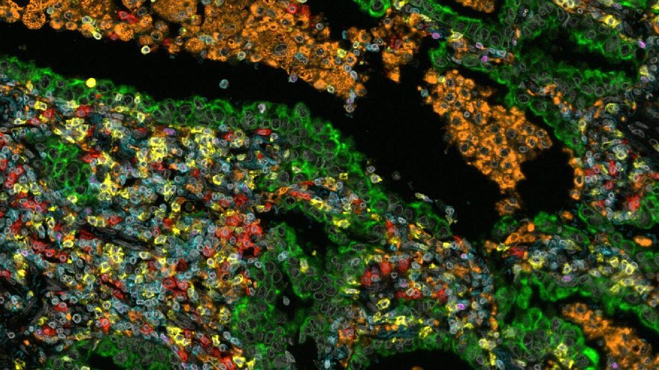 Multiplex Immunhistochemie der Immunzellen in einem nicht-kleinzelligen Lungenkarzinom Großaufnahme von Immunzellen in einem Lungenkarzinom