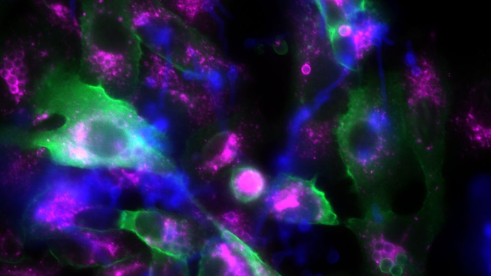 Epithelzellen (große, unregelmäßige Strukturen) und Pilzsporen (kleine, kugelige Strukturen) Fluoreszenzmikroskopisches Foto von Epithelzellen und Pilzsporen