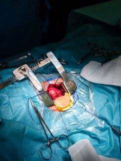 Im Operationssaal haben die Ärzte das Herz eines Rhesusaffens freigelegt, neben Operationsbesteck liegt auch das Herzpflaster bereit.