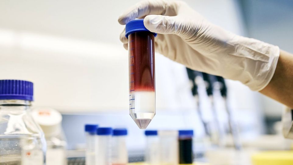 Bei der adoptiven T-Zell-Therapie werden patienteneigene Immunzellen aus dem Blut isoliert und im Labor therapiespezifisch modifiziert und vermehrt. Anschließend werden sie den Patienten wieder zugeführt und zerstören Tumorzellen. Blutprobe