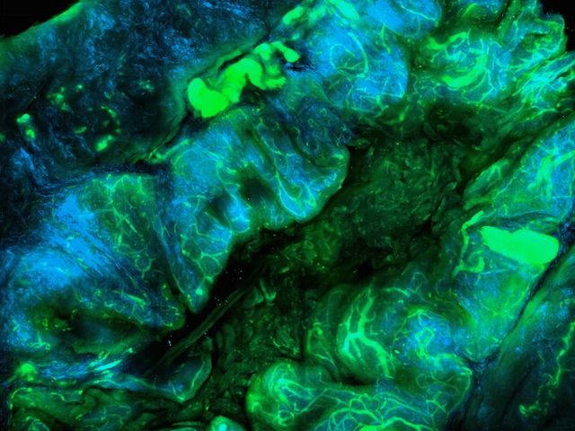 Mikroskopische Aufnahme von Krebszellen